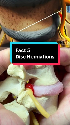 Fact 5- DISC HERNIATION What it is: A disc herniation happens when the soft center of a spinal disc pushes out through the outer layer and irritates a nearby nerve. Why it hurts: It’s not the disc itself — it’s the chemical and mechanical irritation of the nerve, which is why patients feel arm pain or leg pain more than back pain. Key misconception (important): Not all disc herniations need surgery. In fact, most improve with time, physical therapy, or injections. When surgery matters: Surgery b