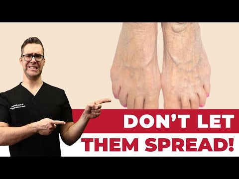 25 BEST HOME Remedies For Spider Veins And Varicose Veins!