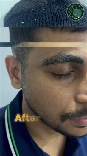 Eyebrow Microblading | Get Natural Perfect Brows | Mahendra Hair Transplant & Skin Clinic