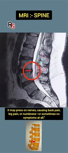 “Disc Bulge on MRI ⚠️ Don’t Ignore These Signs!” #radiology #mri #shorts
