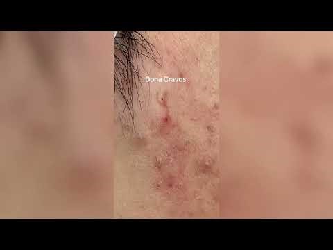 Popping huge blackheads and Pimple Popping - Best Pimple Popping Videos #53