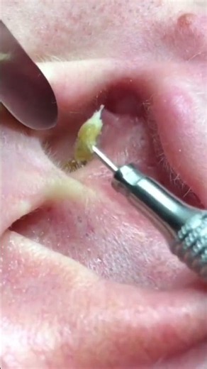 Fat buildup inside the ear piercing #BlackheadRemoval #Blackheads
