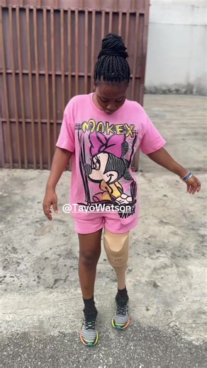 Amputee's Prosthetic Leg Transformation | Before & After