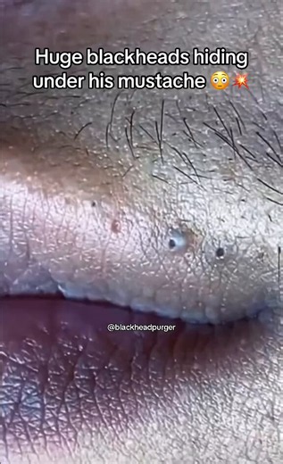 DC on X: "Blackhead extraction under the mustache deep pore cleaning, ultra satisfying close-up! Hidden blackheads finally removed from the upper lip area. You won't believe how big they are #blackheads #skincare #porecleaning #asmr" / X