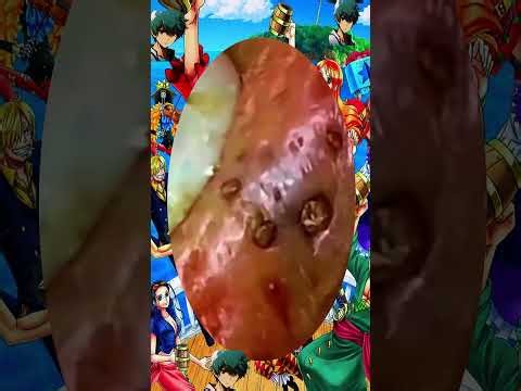 Satisfying Blackhead Removal | Acne Treatment, Pimple Pop & Deep Skin Clean-Up