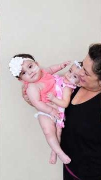 Eva & Erika: Conjoined Twins Who Shared an Extra Leg... How Did Doctors Separate Them?