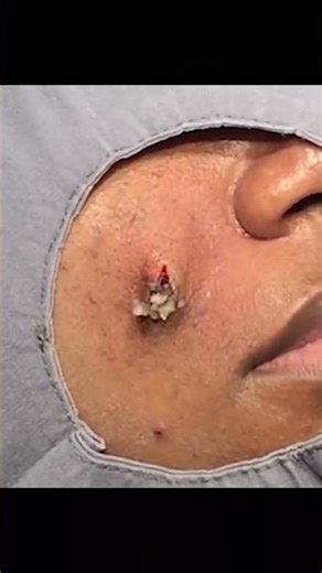 CHUNKY CYST CHEEK SQUEEZE - REMOVING A CYST ON THE CHEEK - WHAT THE INSIDE OF A CYST LOOKS LIKE