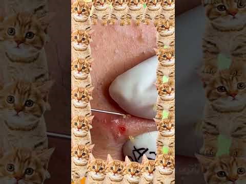 Blackheads Removal | Acne Treatment and Very Satisfying Satisfying Pimple pop #blackheads
