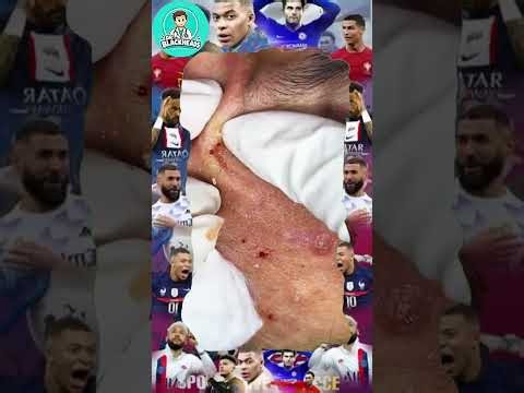 Huge Blackheads Removal | Acne Treatment and Very Satisfying Cystic Pimple pop #blackheads