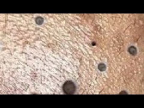Best Satisfying Pimples Popping Cyst Removal Acne Blackheads Explosive Compilation Videos #294