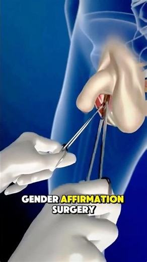 Male to Female Gender Affirmation Surgery (3D Animation) #medicalanimation #healthcare #fyp