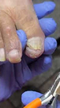 Fascinating toenail trimming process…#pedicure #satisfying