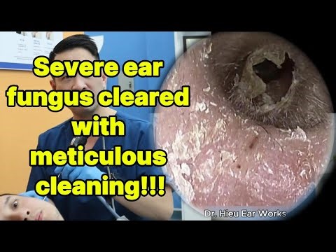 Severe ear fungus cleared with meticulous cleaning | ear cleaning | ASMR earwax | soothing |relax|