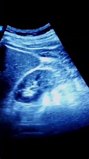 Renal cyst #viral #renaldisease #kidneydisease