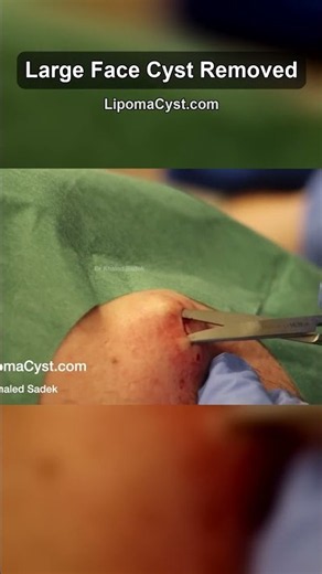 Dr Khaled Sadek. LipomaCyst.com