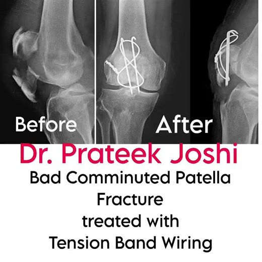 Bad Patella Fracture Surgery | Tension Band Wiring | Dr. Prateek Joshi #ortho