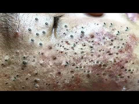 Feel The Extraction Through The Screen | Pimple Popping #800122