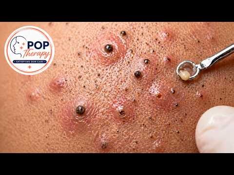 Pop Therapy EP.1 | Satisfying Pimple Popping & Blackhead Removal | Extreme Acne Extraction