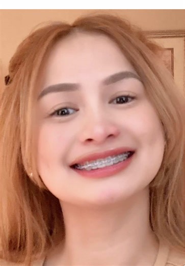 Braces with TADs: Hair Color Tips and Insights