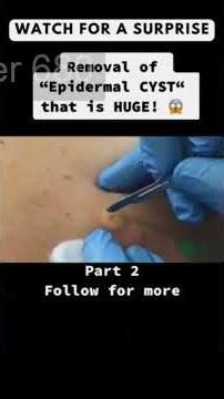 Removing large blackheads and pimples from face new 2026 #133