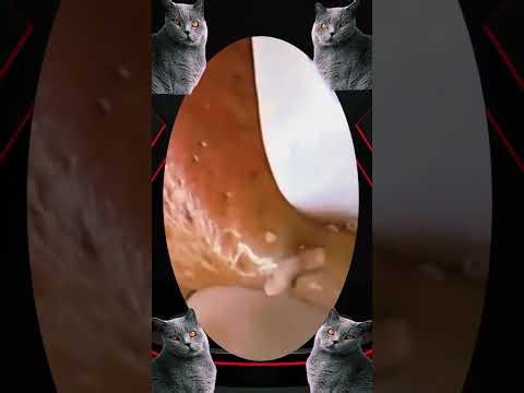 Blackheads Removal | Acne Treatment and Very Satisfying Satisfying Pimple pop #blackheads