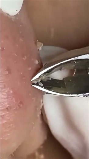 Ultimate Acne Extraction | Relaxing Blackhead Removal & Skincare Treatment #003