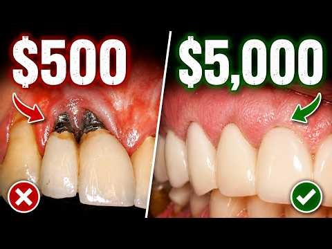 Why Are Dental Implants So Expensive? The REAL Cost Breakdown