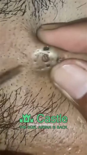 Satisfying self-cleaning of blackheads Acne Treatment Pimple pop #blackheads #acne