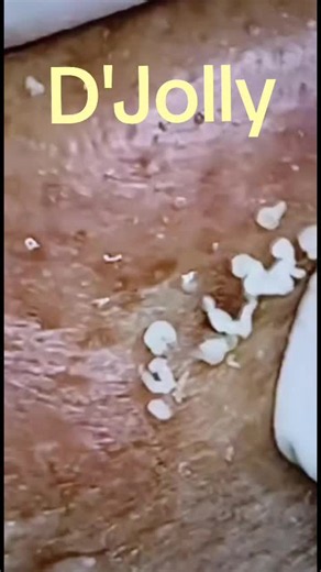 #noseblac #blackheadextractions #squeezing #pimplepopping | cleaning nose
