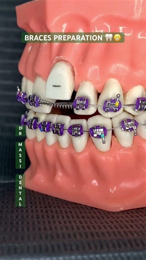 BRACES PREPARATION 🦷😬