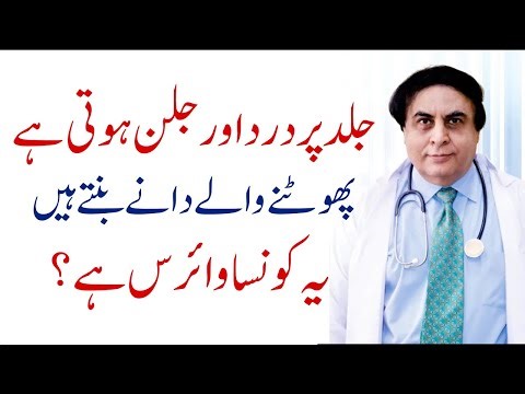 What Is Shingles? Painful Viral Nerve Disease on Skin - Symptoms & Treatment | Dr Khalid Jamil