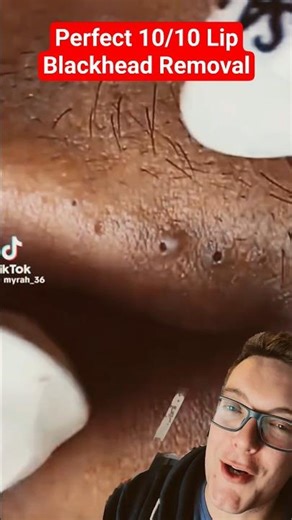 The Perfect LIP BLACKHEAD REMOVAL - Stunning #shorts