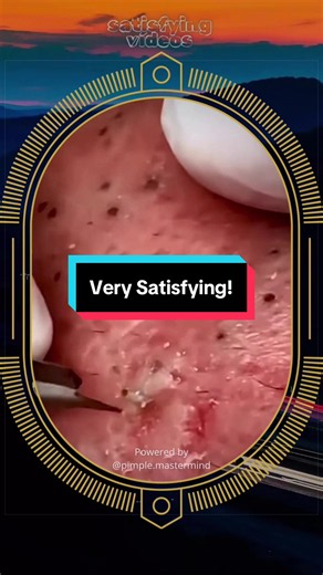 Blackheads removal at SPA Skincare Satisfying Video #blackheadsremoval #blackhead #acnetreatment #skincare #satisfying