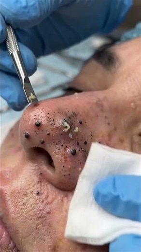 Extracting Blackheads and Pimples — Deep Skin Cleansing! 😱✨