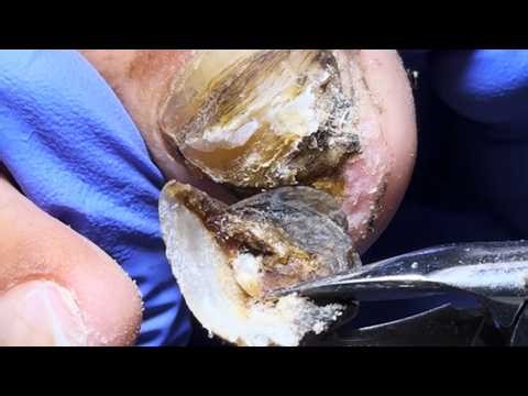 The Inside Of The Toenails Seems To Be Moldy, So Cut Them Clean【Dr. Liu's Pedicur】