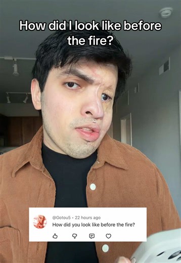 Overcoming Adversity: A Burn Survivor's Journey