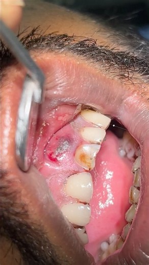 Dental Abscess | Periodontal Abscess