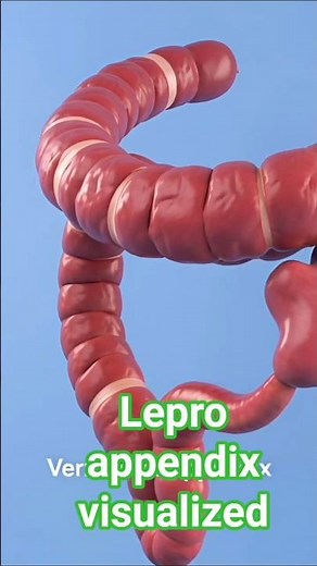 Appendix visualized #health and surgery with sami #appendix #appendectomy antomy #opration # foryou