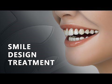 SMILE DESIGN TREATMENT