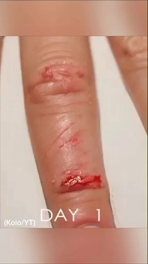 Time lapse of a wound healing 😳 #timelapse