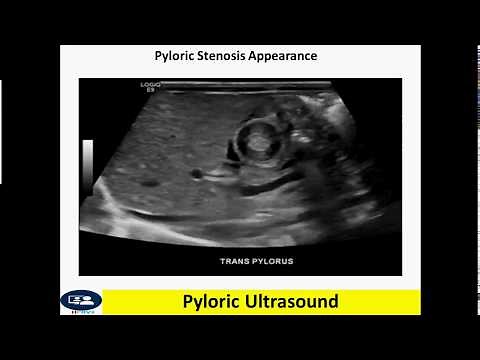 Pyloric ultrasound