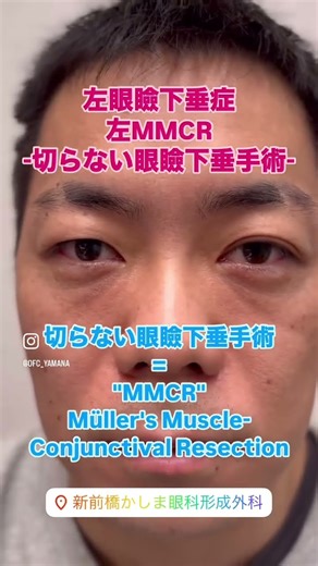左眼瞼下垂(軽度)に対してMMCRを行いました。これは切らない眼瞼下垂手術といわれMüller's Muscle-Conjunctival Resection、が正式名称です。