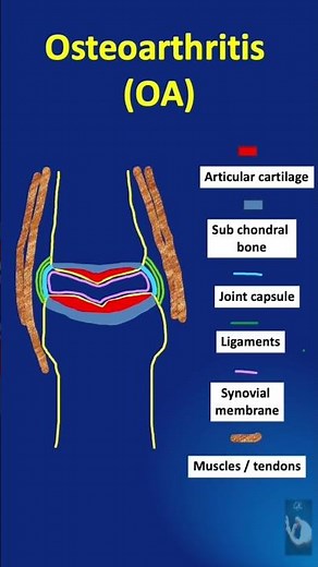 Shorts # 129: Osteo Arthritis in the hand and fingers (OA) - The Clinical features, Heberden nodes