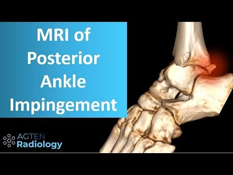 Posterior ankle impingement on MRI