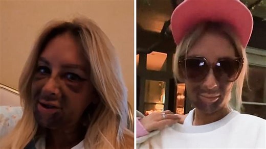 Dental implants leave woman with bruising 'like I had a Rorschach blot test on my face'