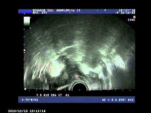 HyCoSy with ExEm Foam, a female fertility sonographic examination. www.GynaecologIQ.com