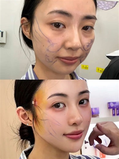 30岁的脸改善后‼️紧致小v脸#facelift #facelifting #smaslifting #VLineFace #FentySuperBrandDay
