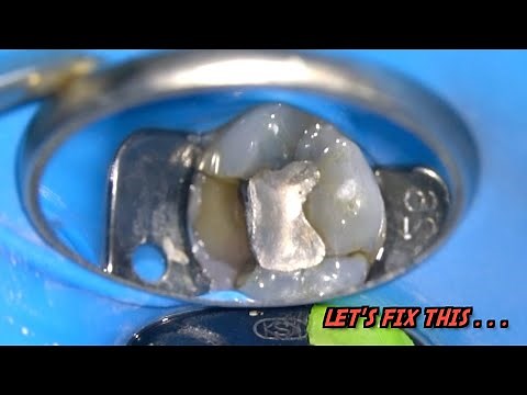 LIVE: Molar Root Canal Treatment | Tooth Decay BENEATH Silver Filling. . .