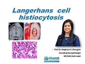 Langerhans cell histiocytosis