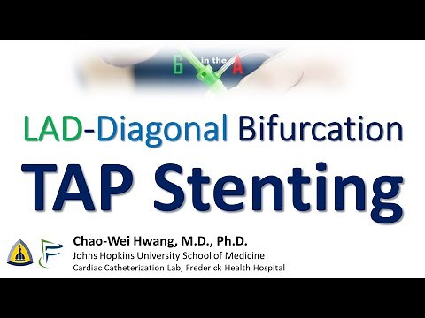 TAP Stenting of LAD-Diagonal Bifurcation